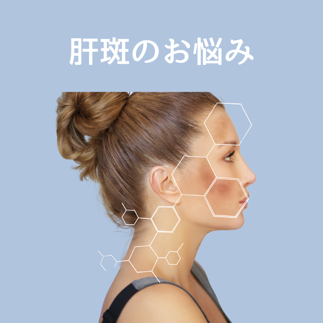 肝斑
